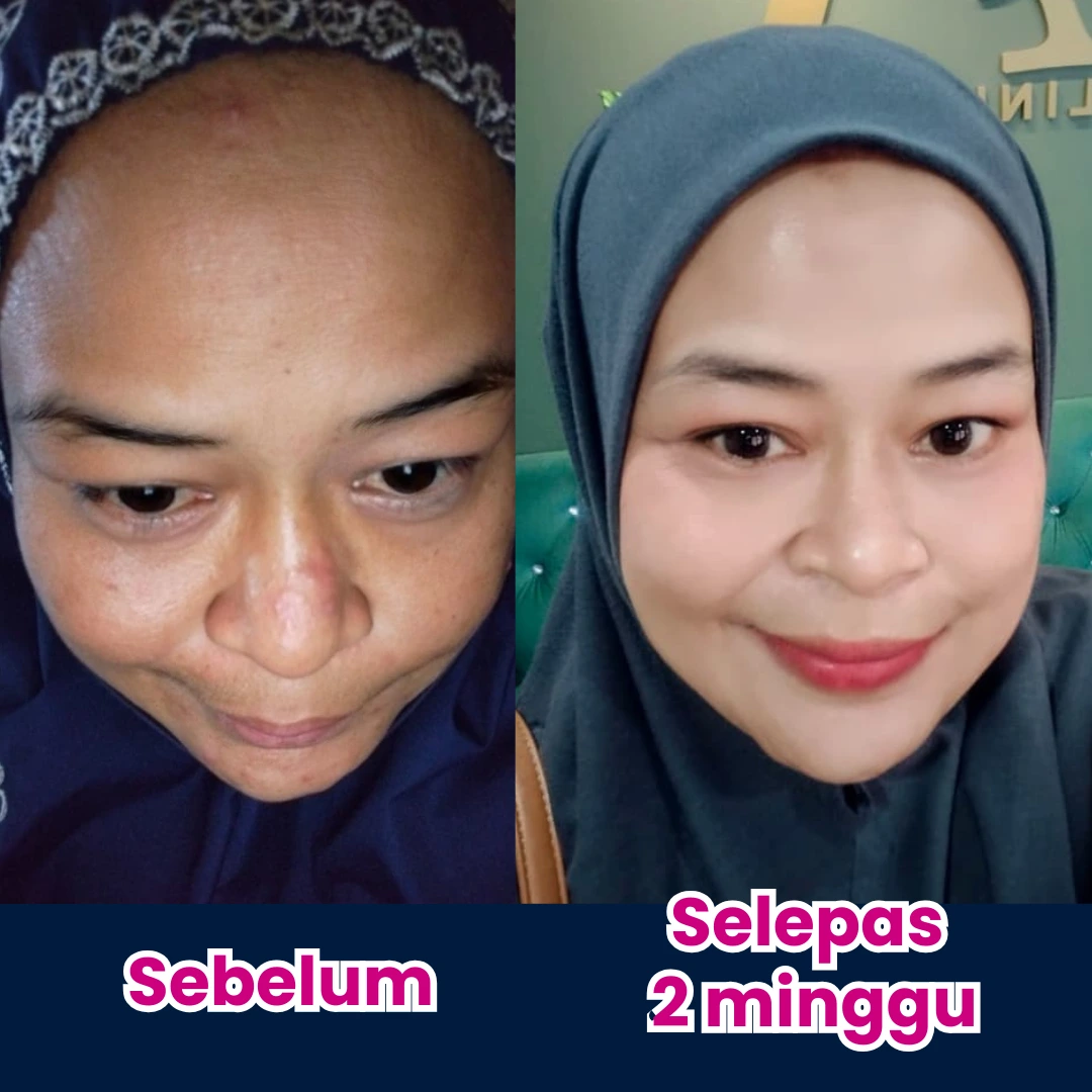 Gambar sebelum dan selepas 2 minggu Puan Zue Zainal menggunakan Sabun HydraGlow dan RetinRadiance Serum